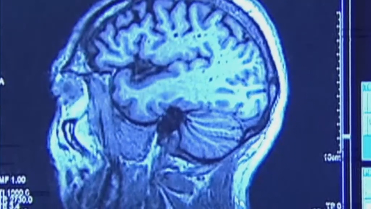 Athletes-Concussions